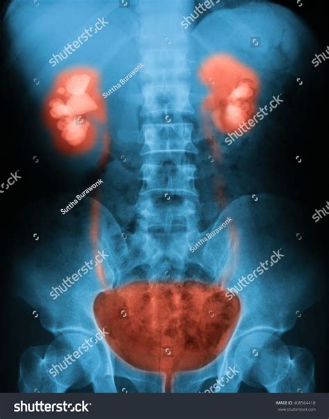 Kidney, Ureter, and Bladder X.